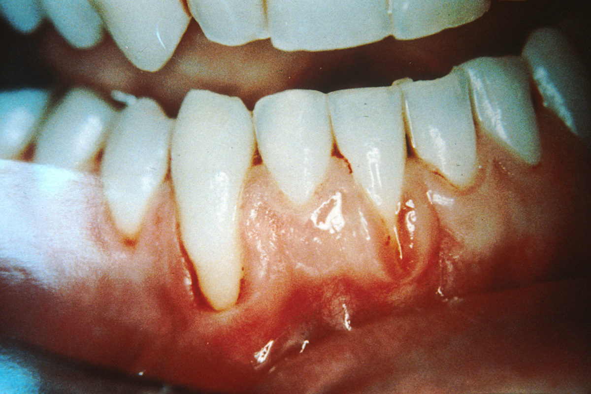 bleeding-gums-treatment-general-center-steadyhealth