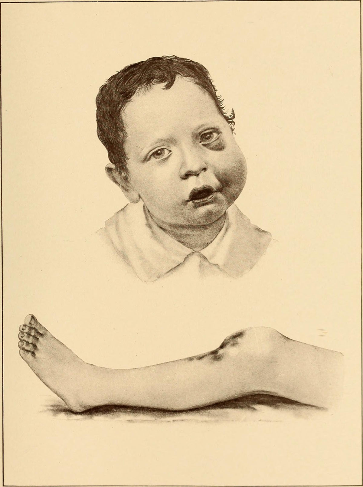 Symptoms Of Haemophilia General Center SteadyHealth
