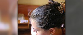 Hair loss in women under 30