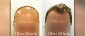 Hair loss surgery