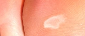 Healing a blister in a diabetic