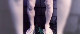Healthy legs