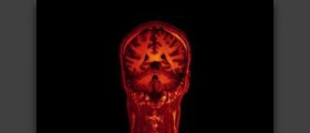 Healthy MRI brain scan