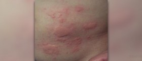Heat rash in babies