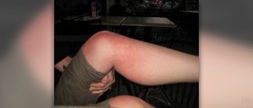 Heat rash remedies