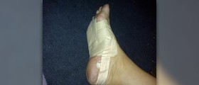 Heel spur symptoms