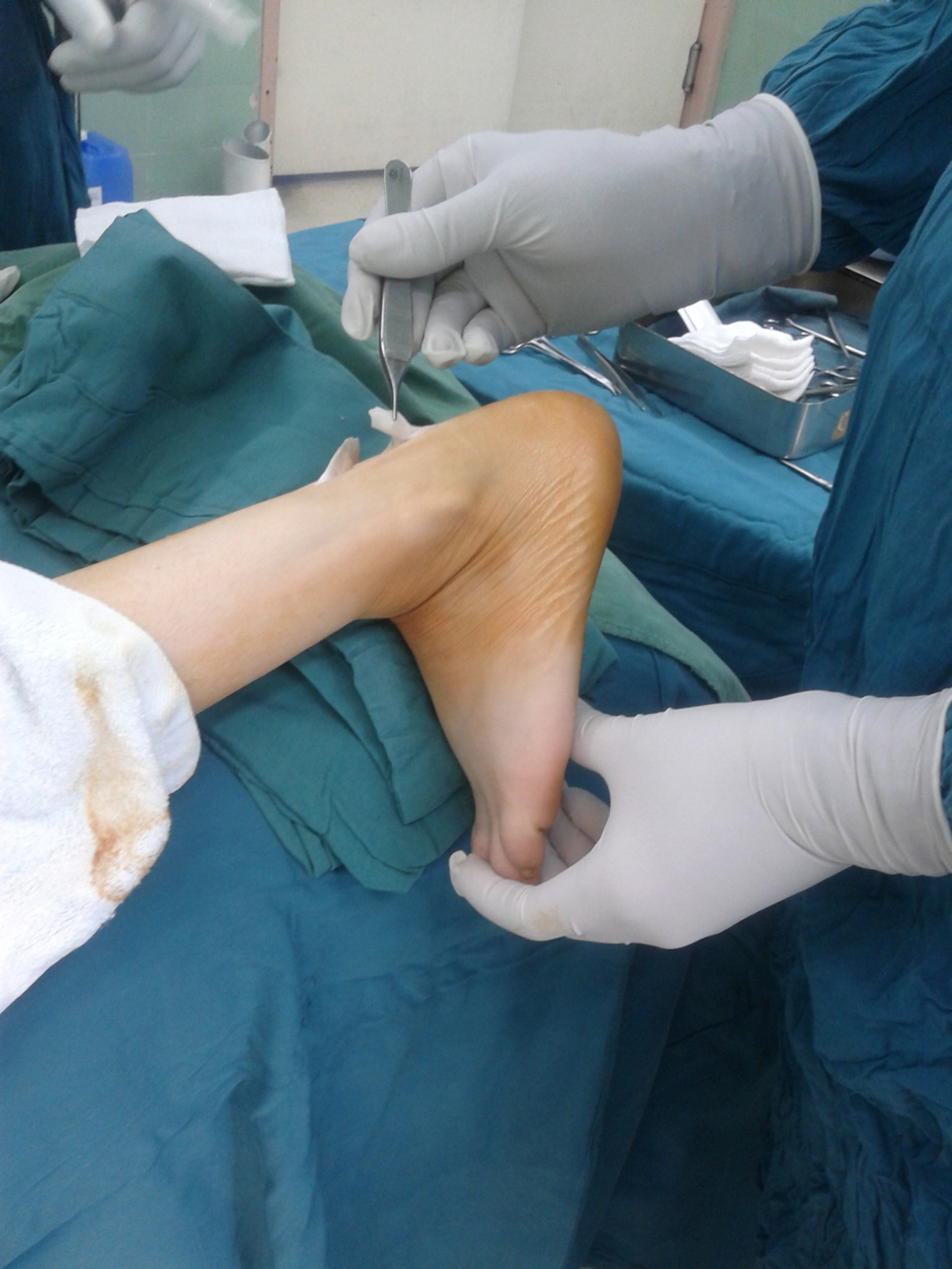 heel-spurs-surgery-general-center-steadyhealth