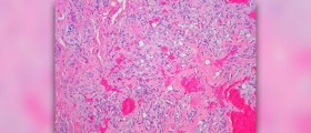 Hemangioma spine facts