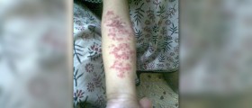 Hemangioma treatment options