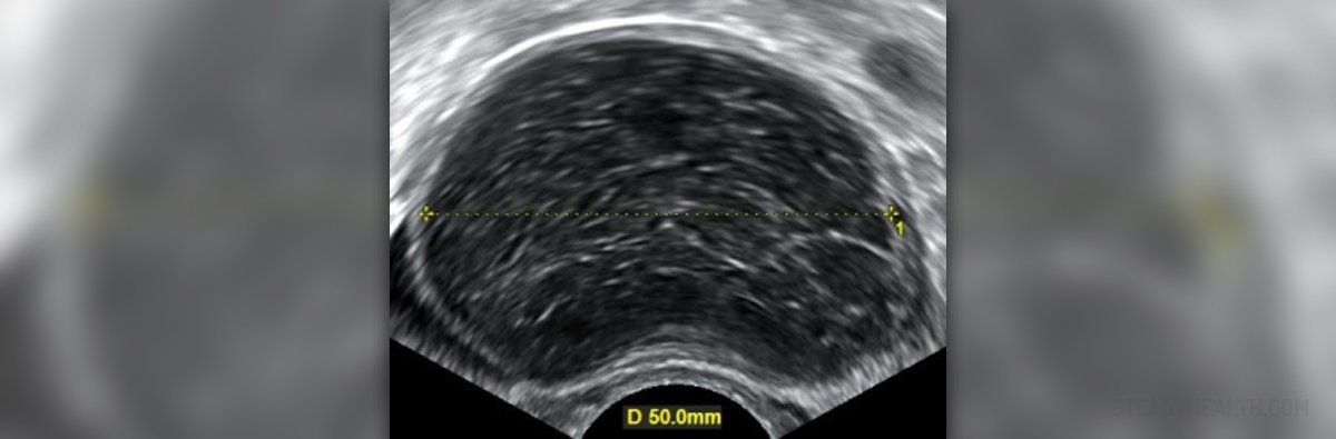 hemorrhagic-ovarian-cysts-symptoms-and-treatment-women-s-health