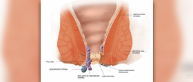 Hemorrhoids cure - home remedies for painful hemorrhoids