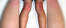 Herbs for eczema