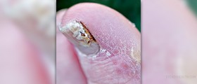 Herbs for nail fungus