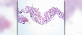 Herbs for nasal polyps