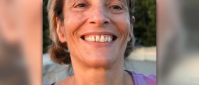 Herbs for periodontal disease