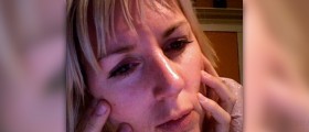 Herbs for rosacea
