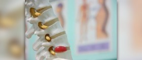 Herniated disc - a true pain in the back!