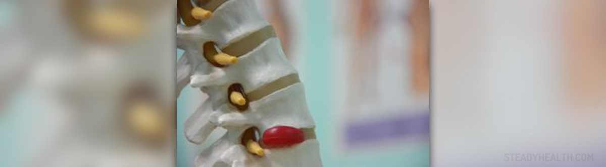 Herniated disc in neck | General center | SteadyHealth.com