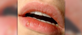 Cold sores during pregnancy
