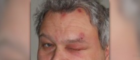 Herpes of the eye: ocular herpes