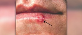 Herpes treatment: natural herbs to cure herpes