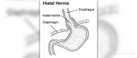 Hiatal hernia and acid reflux