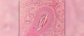 High cholesterol risks