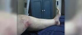 Hip and knee pain