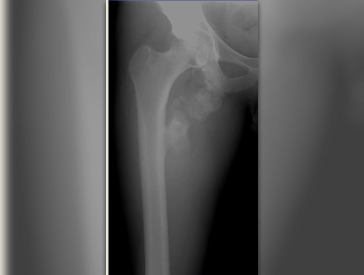 hip-replacement-complications-after-surgery-general-center