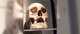 History of Hansen's disease (leprosy)