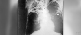 History of tuberculosis