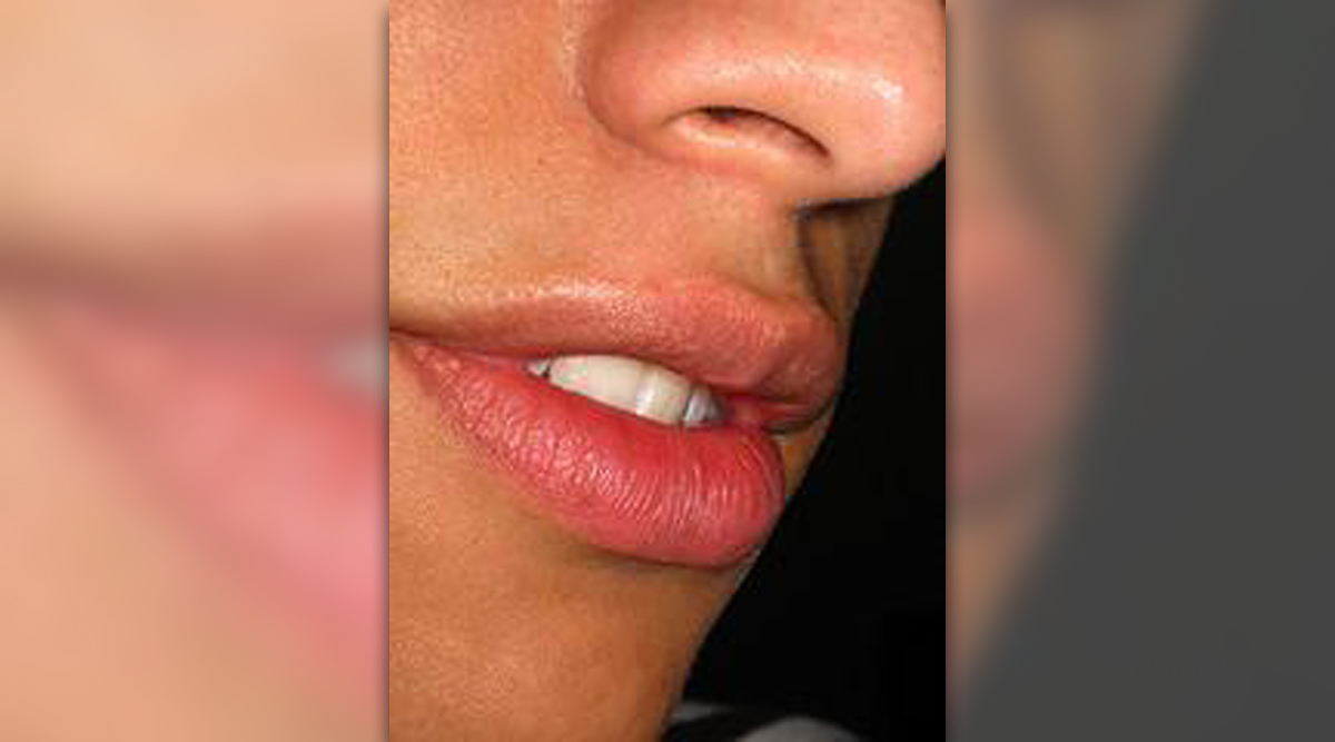 home remedies for cold sores in mouth