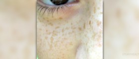 Home remedies for freckles