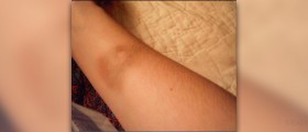 Home treatment for bruises