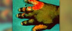 Home treatment for frostbite
