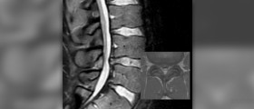 Home treatment for herniated disc