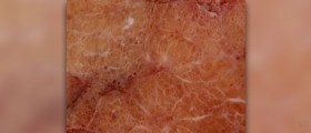 Home treatment for hyperthyroidism