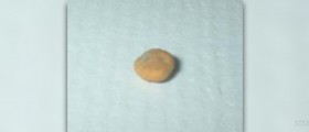 Home treatment for kidney stones