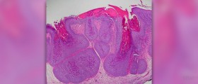 Home treatment for molluscum contagiosum