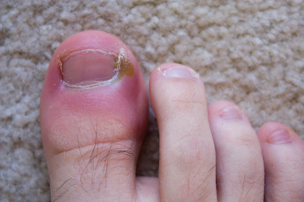 What Cream Is Best For Infected Toe