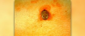 Home treatment for tick bites