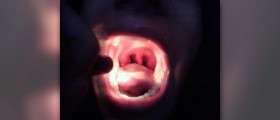 Home treatment for tonsillitis