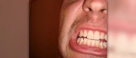 Home treatment for yellow teeth