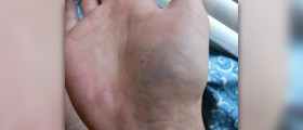 Homeopathic remedy for bruising
