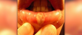 Homeopathic remedy for canker sores