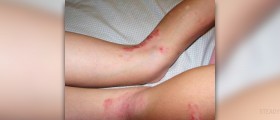 Homeopathic remedy for contact dermatitis