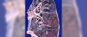 Homeopathic remedy for emphysema