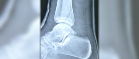 Homeopathic remedy for fractures