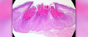 Homeopathic remedy for molluscum contagiosum