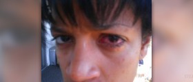 Homeopathic remedy for pink eye